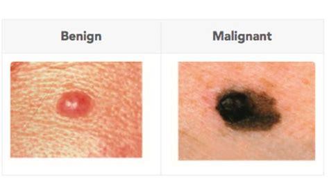 Skin Cancer Symptoms The Difference Between Normal And Cancerous Moles On Your Body Freeschi