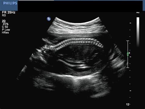 Spina Bifida Ultrasound 17 Weeks