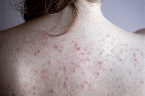 Back Acne And Body Acne Treatment Guide Singapore Edwin Lim Medical