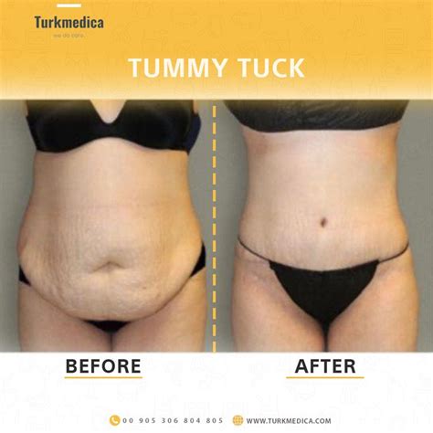 Tummy Tuck Tummy Tucks Abdominoplasty Excess Skin