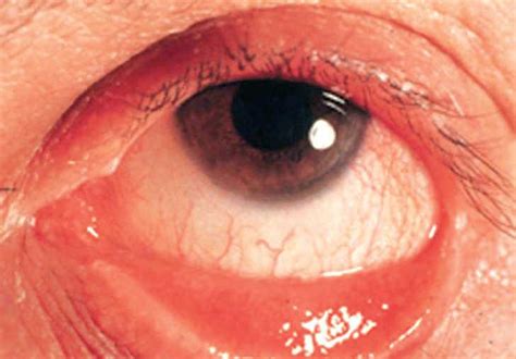 Infecciones Oculares Offarm