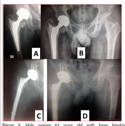 Figure 1 From Cementless Long Stem Total Hip Replacement For Revision