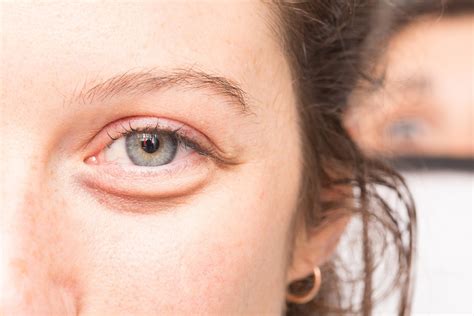 How To Treat A Swollen Eye 4 Fantastic Natural Ways How To Cure