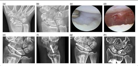 Figure 2 From Arthroscopic Bone Grafting And Scapholunate Fixation In