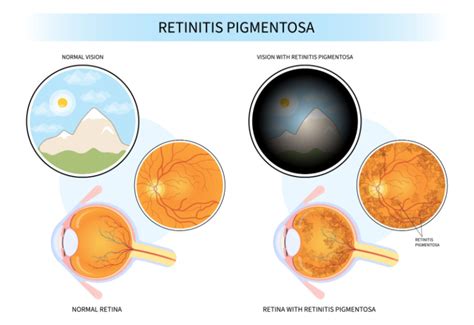 What Is Retinitis Pigmentosa Fort Lauderdale Eye Institute
