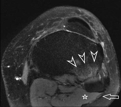 Axial Fat Saturated Proton Density Mr Image Of The Left Knee From An Download Scientific