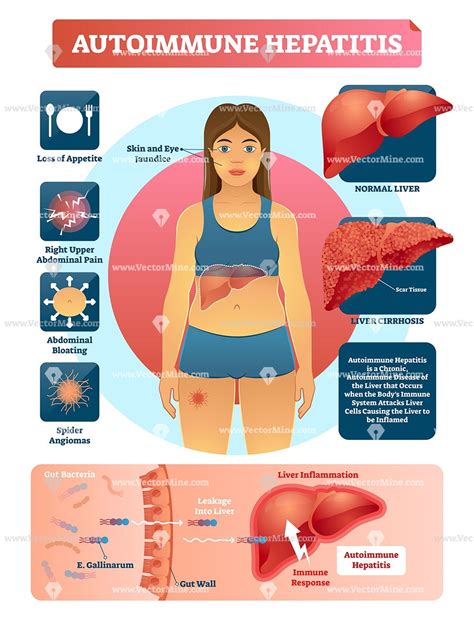 Autoimmune Hepatitis Medical Vector Illustration Infographic Autoimmune