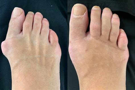 Bunion Surgery Before And After Northwest Surgery Center