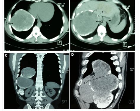 Ct Scan Images Showing The Trans Diaphragmatic Hydatid Cyst A 1
