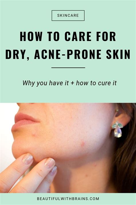 How To Deal With Acne And Dry Skin