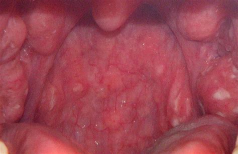 Pictures Of White Spots On Back Of Throat
