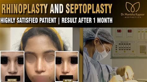 Nose Surgery Transformation Healing Process Over One Month Dr Monisha Kapoor Delhi India