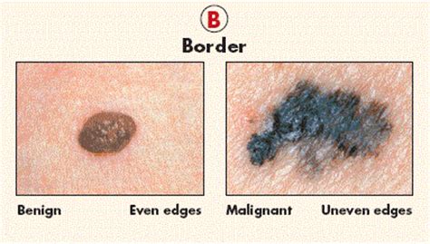 Maybe you would like to learn more about one of these? What Does Melanoma Look Like? | New Health Advisor