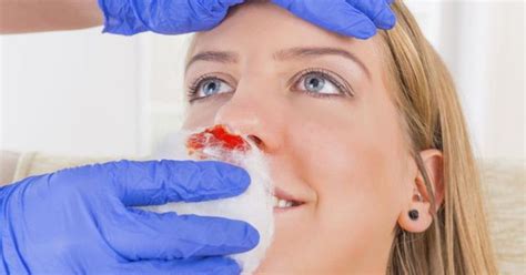 A nosebleed can be scary, but it's rarely cause for alarm. How Nosebleeds May Point to Vitamin Deficiencies | Nose ...