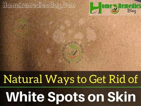 How To Get Rid Of White Spots On Skin Naturally Skin Spots White
