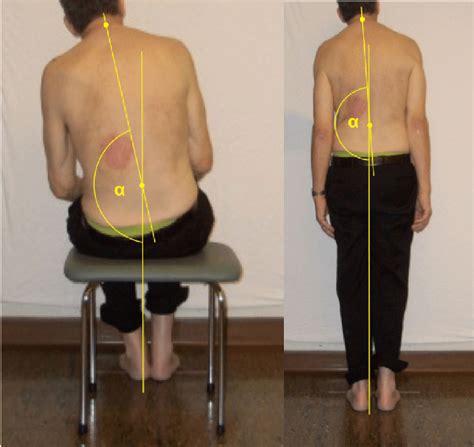 Illustration Of The Trunk Measurement In The Sitting And Standing