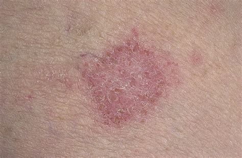 Nervous Eczema Pictures 64 Photos And Images