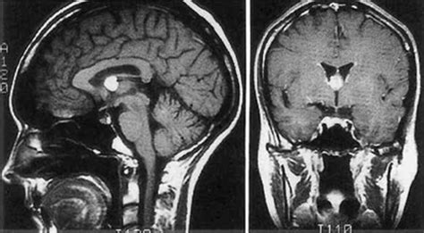 Surgical Resection Of Third Ventricle Colloid Cysts In Journal Of