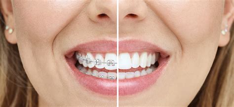 How Long Will It Take For Invisalign Work Invisalign Griffith Dental
