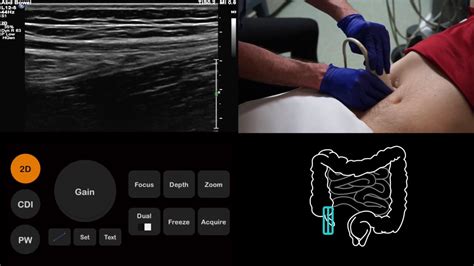 Ultrasound Tutorial Appendixappendicitis Radiology Nation Youtube