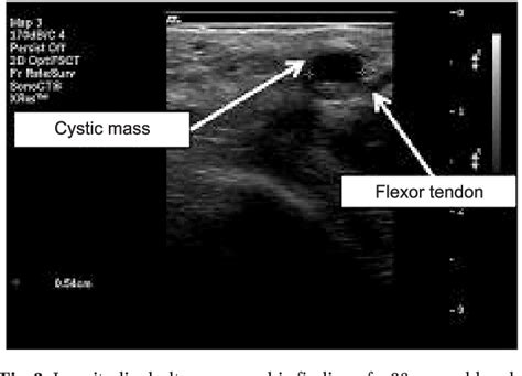 Figure 2 From Ganglion Of The Flexor Tendon Sheath Between A1 Pulley