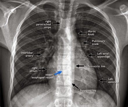 Video includes the following image (among others): Chest X Ray Part 1- Normal Anatomy And ItsVariants ...