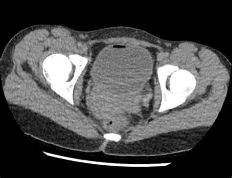 Emphysematous Cystitis With Bilateral Pyelonephritis In A Pediatric