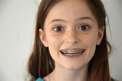 Girl With Dental Braces Stock Photo Image Of Cute Children 90892828