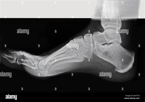 Side View Of An Adult Foot In An X Ray Stock Photo 63701607 Alamy