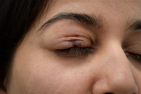 Woman Who Ripped Her Eyelid Open On A Nightout Has An Eyelash Transplant Metro News