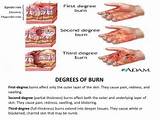 Degrees Of Burns