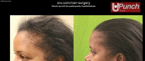 First of all afro hair transplants are becoming very popular. Black Female Hair Transplant 1 | HairSite.com