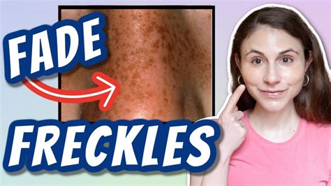 How To Fade Freckles Dr Dray Youtube