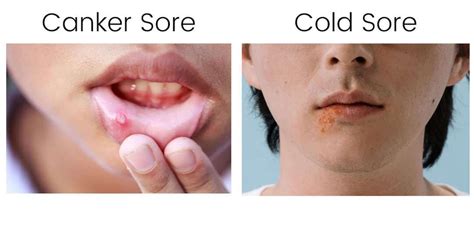 canker sore vs cold sore what s the difference with pictures — canker shield
