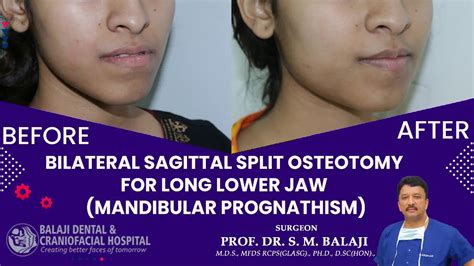 Bilateral Sagittal Split Osteotomy For Long Lower Jaw Mandibular