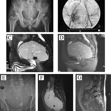 The Computerized Tomography Ct Scans Of Patient B Before And After
