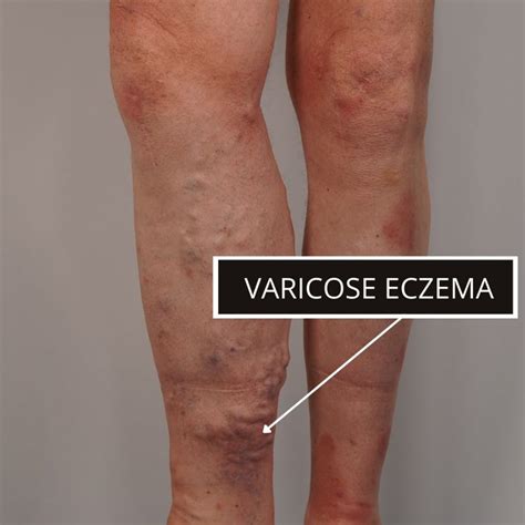 Varicose Eczema The VeinCare Centre