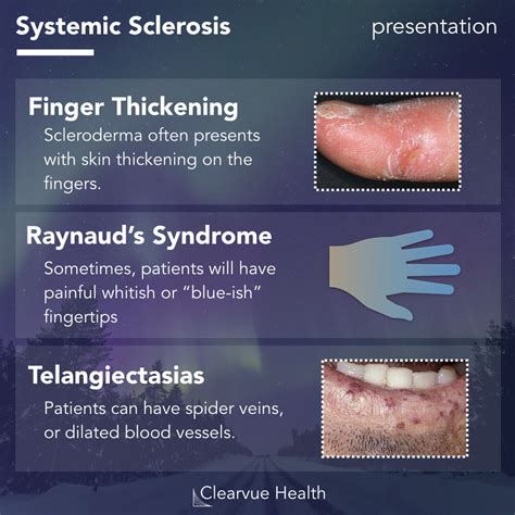 systemic sclerosis