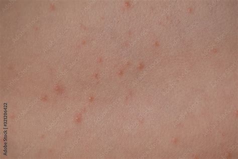 Large Spots And Pimples Acne On The Body Are Sweating Viral Eczema