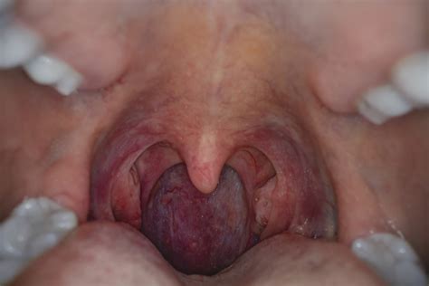 Hpv Throat Cancer Risk Factors Symptoms Treatment And More My Xxx Hot