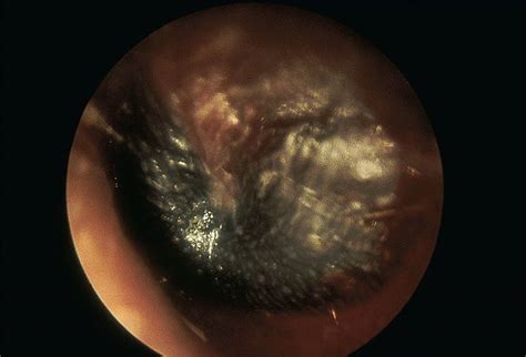Tympanic Membrane Abnormalities Visual Diagnosis And Treatment In