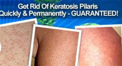 Keratosis Pilaris Treatment Before And After Youtube
