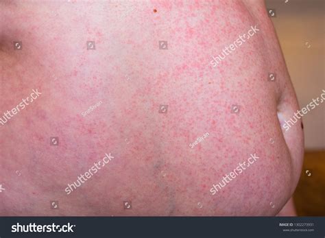 Skin Rash Allergic Reaction Red Spots Stock Photo 1302273931 Shutterstock