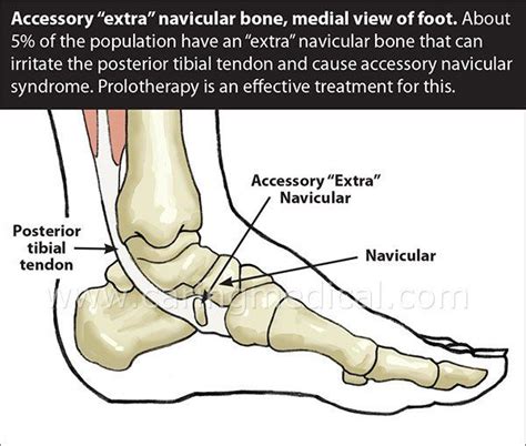 Accessory Navicular Syndrome Syndrome Bones Accessories