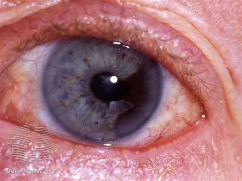 Eye Cancer Symptoms Medizzy