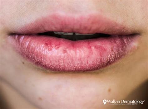 Ashy Lips Disease Lipstutorial Org