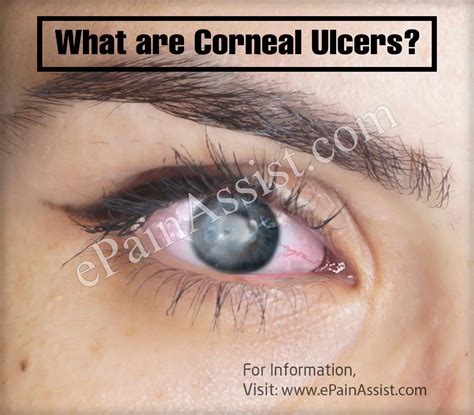 Types Of Corneal Ulcers