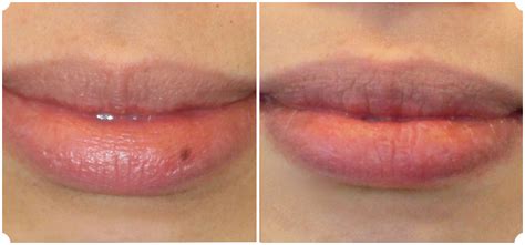 Freckle On Lip Removal