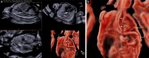 Sonographic Demonstration Of Fetal Esophagus Using Three‐dimensional