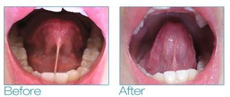 Lingual Frenulum Cut